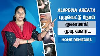 Alopecia Areata Treatment at Home in Tamil | தலை முடியில் புழு வெட்டு | பூச்சி வெட்டு தீர்வுகள்