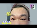 중년남성 이마거상술 깊게 패인 이마주름과 미간주름 지긋지긋하셨죠 eng sub