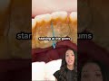 plaque vs tartar on teeth dental calculus shorts