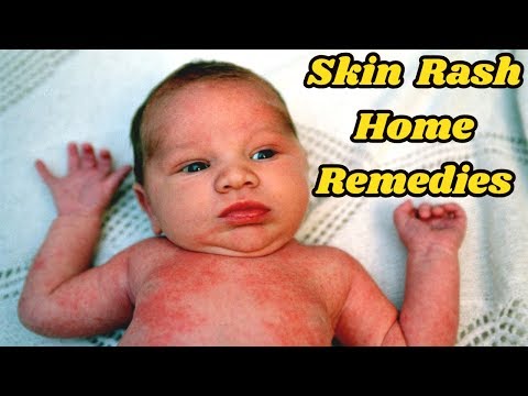 5 Simple Home Remedies For Rash On Your Baby’s Body #NaturalRemedies 5 Simple Home Remedies For Rash On Your Baby’s Body #NaturalRemedies