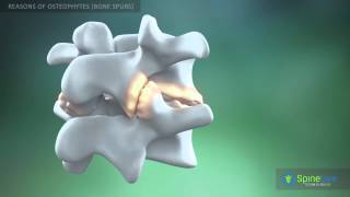 Osteophytes bone spurs Reasons