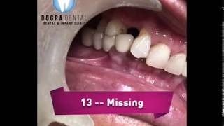 Dental Implant Placement with Ridge Split Technique