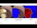 v03 01 automated kidney stone segmentation during ureteroscopy using computer vision techniques