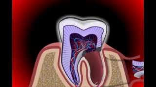 Fractured or Broken Tooth