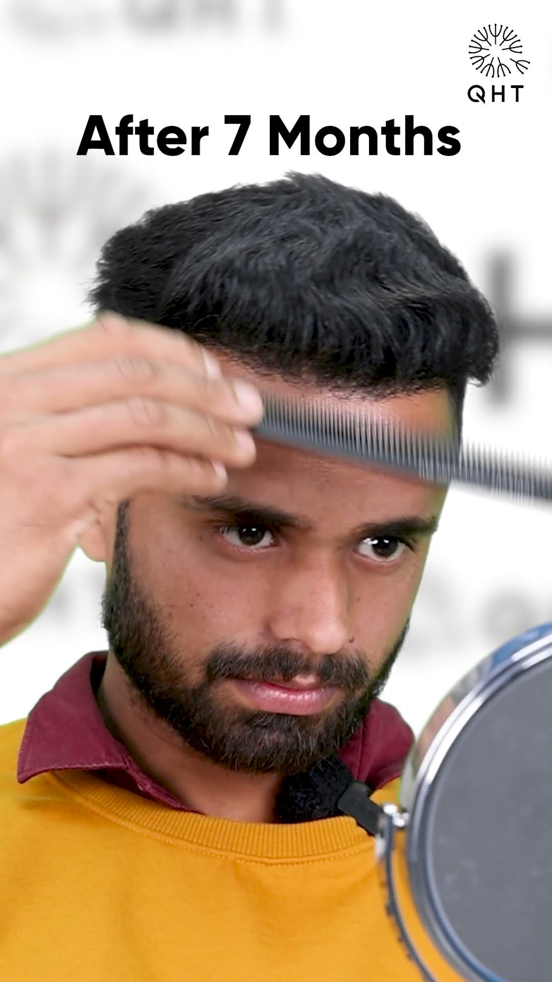 Hair transplant results over seven months Latest Fue technique #shorts #viral #hair transplant