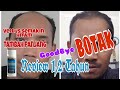 Review Minoxidil 1,2 tahun Untuk Rambut Botak