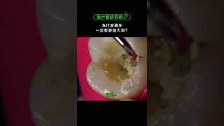 為什麼牙醫補牙一定要磨個大洞？#冷知識 #發現 #为什么