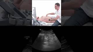 Using the Splenic Vein in #pancreas #ultrasound #shorts