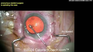 CataractCoach™ 2413: USA senior resident \u0026 ACGME ophthalmology volume