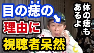 【松浦勝人】目の痣の理由に視聴者呆然。体にも痣がある理由【avex MAX松浦 切り抜き】