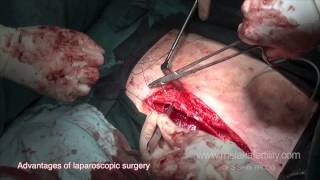 Laparoscopic surgery in gynaecology- an overview