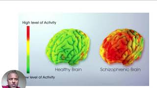 Schizophrenia ஸ்கிஸோபெர்னியா மனநிலை பிரச்சனை பேலியோவால் சரி ஆகுமா?