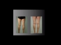 treating veins in both legs simultaneously uip boston 2013 presentation