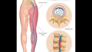 What is Sciatica?