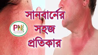 সানবার্ন এর সহজ সমাধান || Sunburn Easy Remedy || How To Prevent Sunburn ||