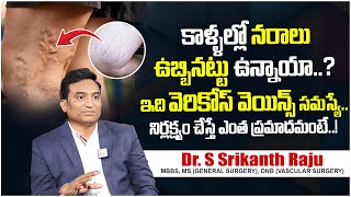 వెరికోస్ వెయిన్స్ సమస్యా.. | Varicose Veins: Causes, Symptoms And Prevention | Dr.S.Srikanth Raju