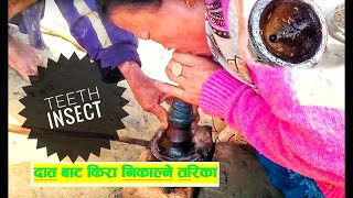 Teeth Insect from Mouth Part-1 | दाँत को किरा निकल्ने तरिका