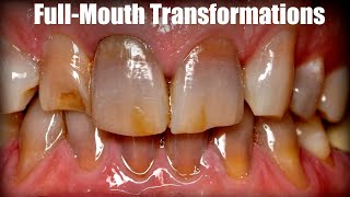 Before \u0026 After: Amazing Full-Mouth Transformations