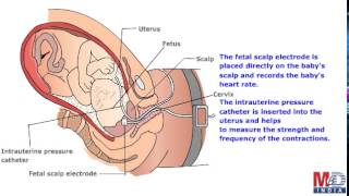 Electronic Fetal Monitoring