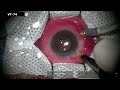 aioc2022 vt74 management of chronic persistent macular hole using autologus ilm graft and ...