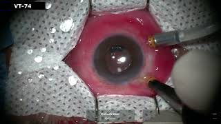 AIOC2022 - VT74 - Management of chronic persistent macular hole using autologus ILM graft and ...