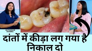 दांतो के कीड़े कैसे निकाले ?| Dental Cavity Treatment | Dant ke  Kide Ka Ilaj In Hindi