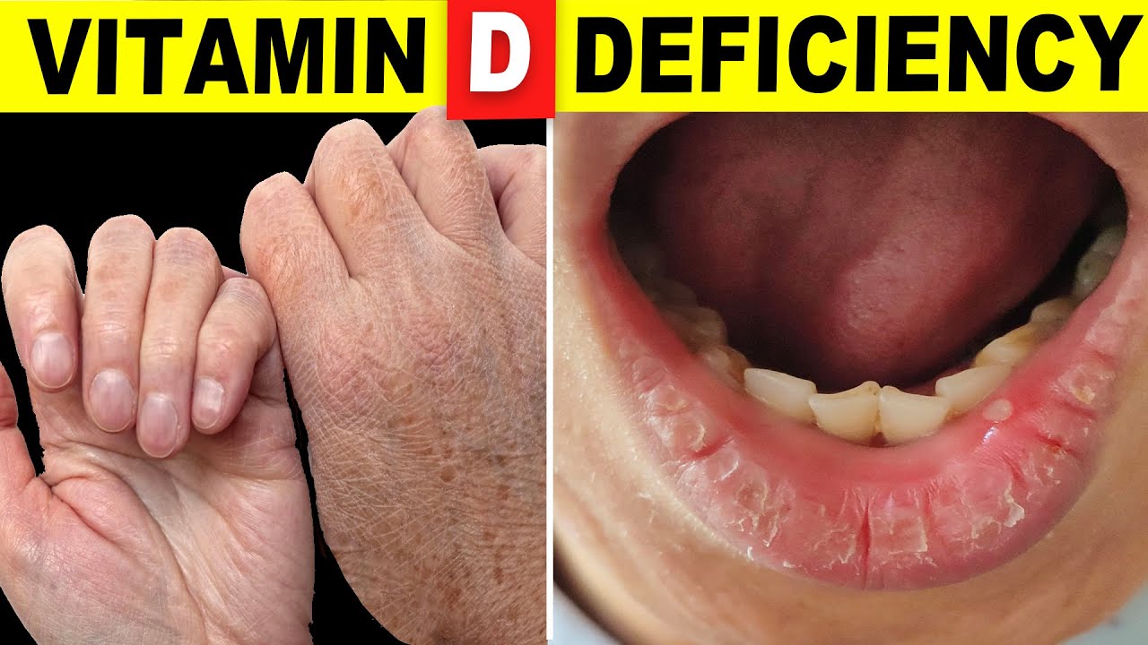 10 Signs Your Body Is Begging For Vitamin D - YouTube