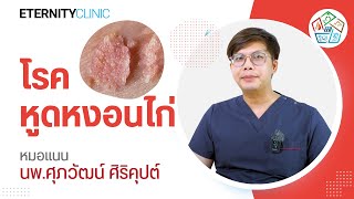 หูดหงอนไก่ สาเหตูที่เกิดจากการมีเพศสัมพันธ์ | Excellent Equilibrium Wellness