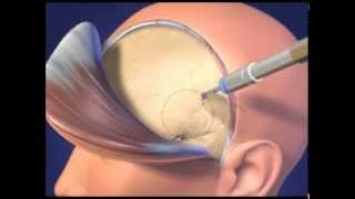 Hrayr Shahinian M.D. Presents Traditional Pterional Craniotomy