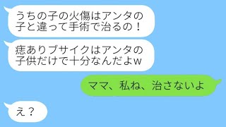 顔にアザがある息子を見下して熱湯をかけようとした義姉「かっこいいねw」→その後、開き直った義姉の娘が顔に大やけどを負った理由が…w