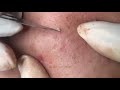 suri job 106 inflamed acne on cheek