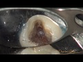 Removal of fractured root canal instrument