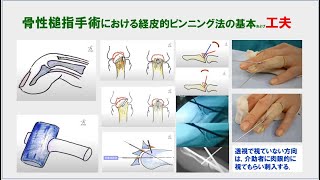 （19分27秒）骨性槌指手術における経皮的pinning法の基本および工夫