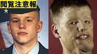 【閲覧注意】 顔の移植手術を受けた米国人兵士