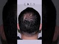 Hair Transplant Before and After Results