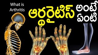 20 ఏళ్లుగా ఉన్న మీ కీళ్ల నొప్పులు కూడా ఒక్కరోజులో తగ్గిపోవాలంటే ఒక్కసారి ఇలా చేయండి | Cure Arthritis