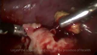 Laparoscopy Appendectomy