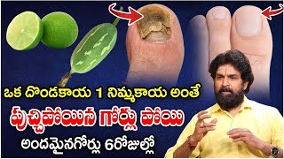 పుచ్చిపోయినా గొర్లకు, గోరుచుట్టు కు మాయం చేసే చిట్కా || Goru Chuttu Home Remedy || Vikram aditya