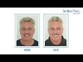 Full Mouth Dental Implants at Smiles Peru