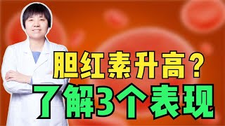 了解胆红素升高的3个表现，关注肝脏健康