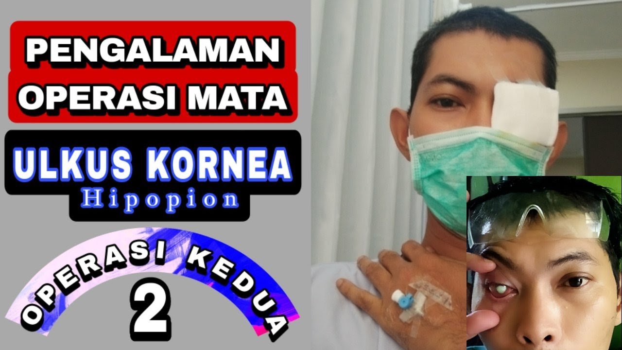 Pengalaman Pribadi Operasi Mata Ulkus Kornea Yang Ke 2 Tindakan