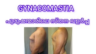 gynacomastia, പുരുഷന്മാരിലെ സ്തന വളർച്ച