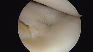 Arthroscopic bucket-handle lateral meniscal repair by Dr. Dold (all-inside technique)