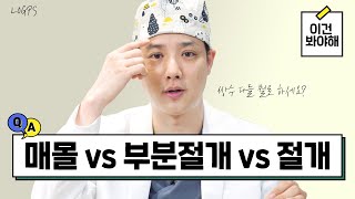 매몰 vs 부분절개 vs 절개, 쌍꺼풀 수술 차이점