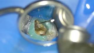 Searching for MB2 on a first molar and cementing a glass fiber post