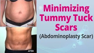 Minimizing Tummy Tuck Scars (Abdominoplasty Scar) - Edelstein Cosmetic - Toronto