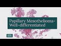 Papillary mesothelioma of the peritoneum