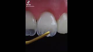 Dental Extraction 🦷 #teeth#tooth#toothless#extraction#cirugiabucal#oralsurgery#dental#dentist