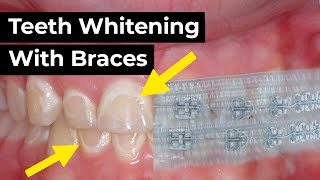 Teeth Whitening With Braces
