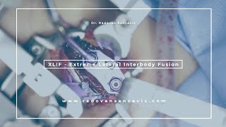 What is an XLIF? (Extreme Lateral Body Fusion) - ENGLISH